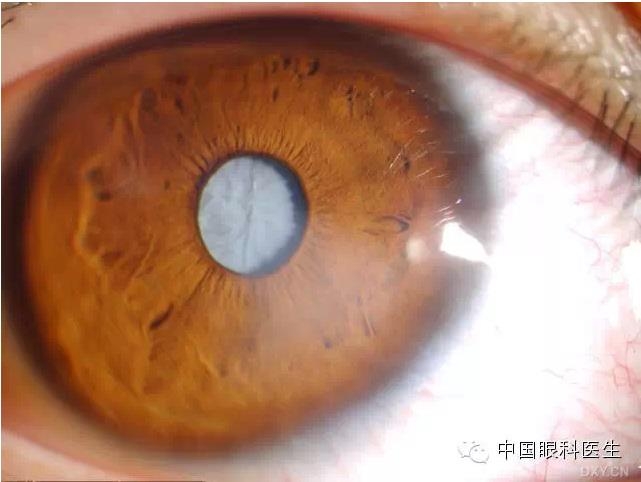 不同眼科疾病的眼前节照片