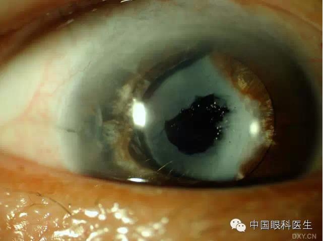 不同眼科疾病的眼前节照片