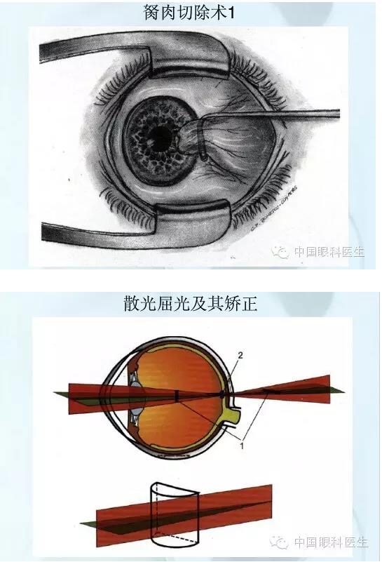 眼科课件常用图谱（收藏，转需，PPT不缺图）