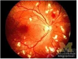 视网膜相关知识学习及病例图片分享