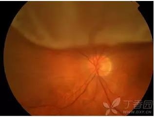 视网膜相关知识学习及病例图片分享