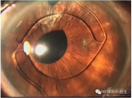 新手眼科医生需要了解的人工晶体